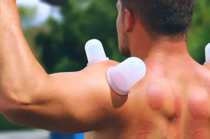 Silicone Cupping: Falua Protocol